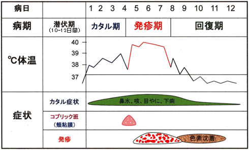 麻疹の経過