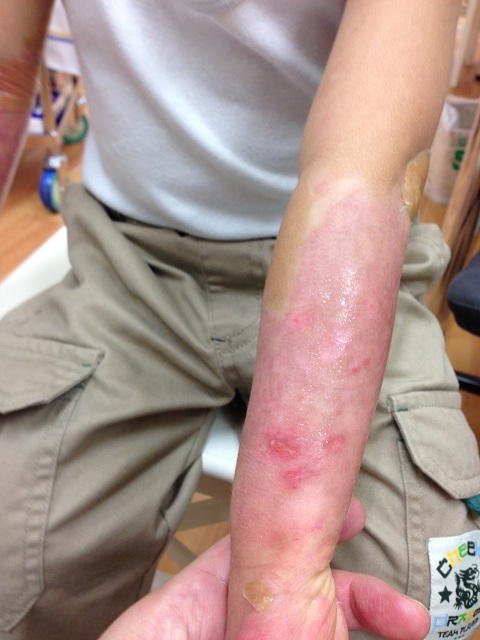 左腕：熱傷後23日、当院での治療9日